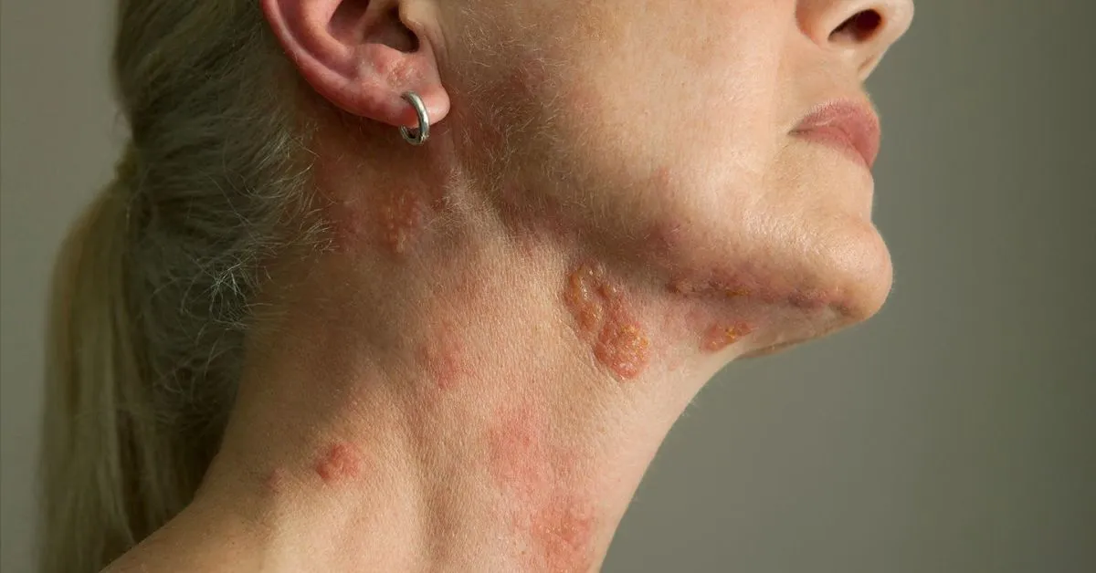 skin-vesicles-causes-symptoms-prevention-treatment