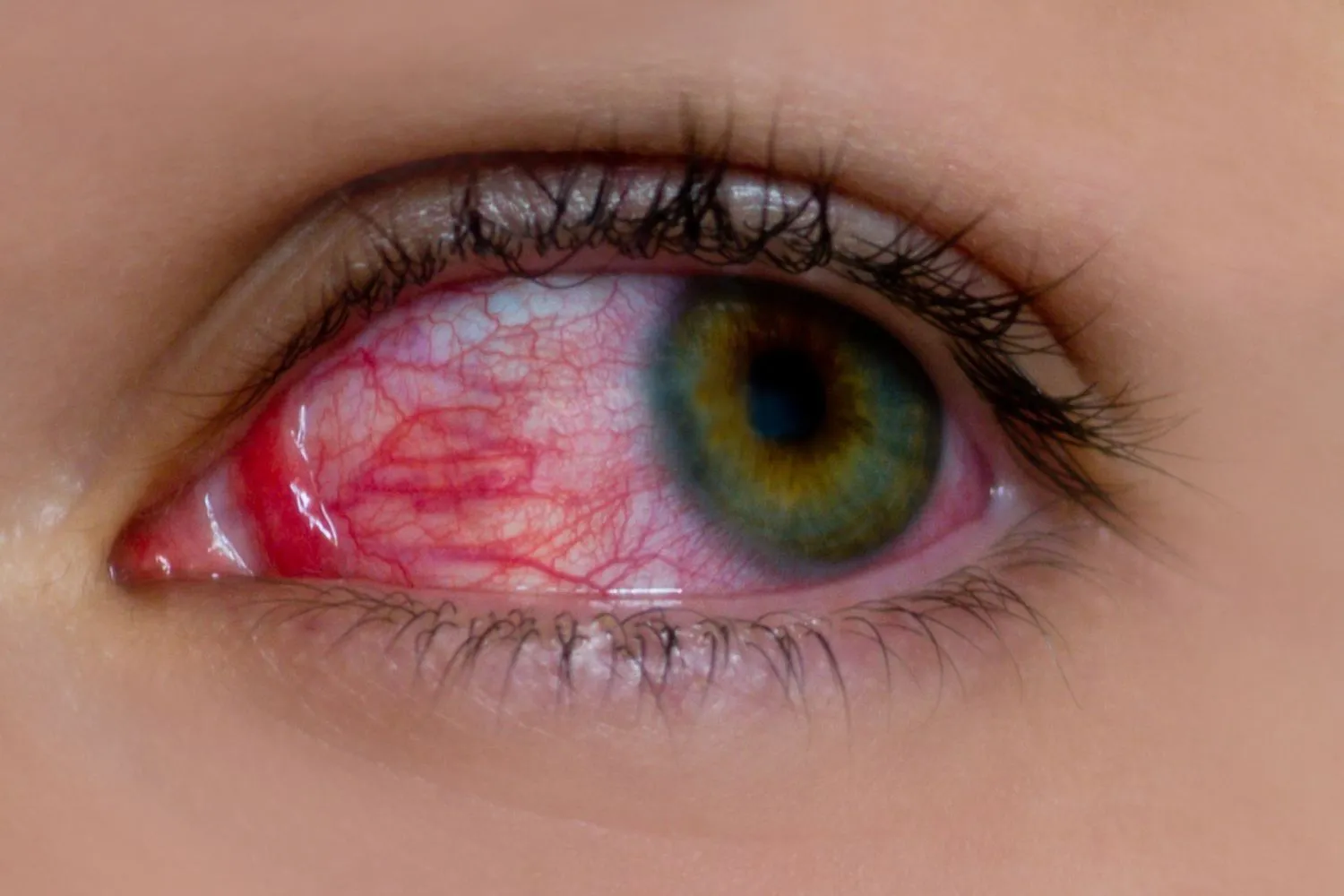 How long pink eye contagious